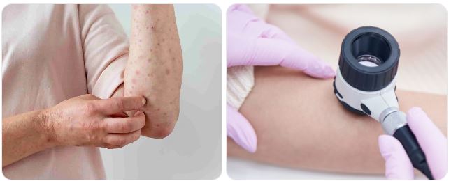 Kanker Kulit: Penyebab, Gejala, dan Pentingnya Deteksi Dini