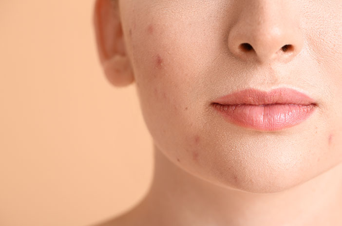 Cara Atasi Kulit Berjerawat dengan Skincare Simple tapi Efektif