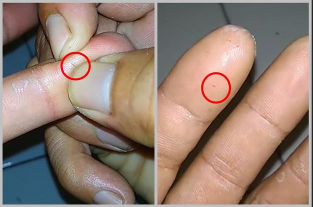 Jangan Panik! Ini Cara Aman Mengeluarkan Duri di Tangan Tanpa Bikin Luka Makin Parah