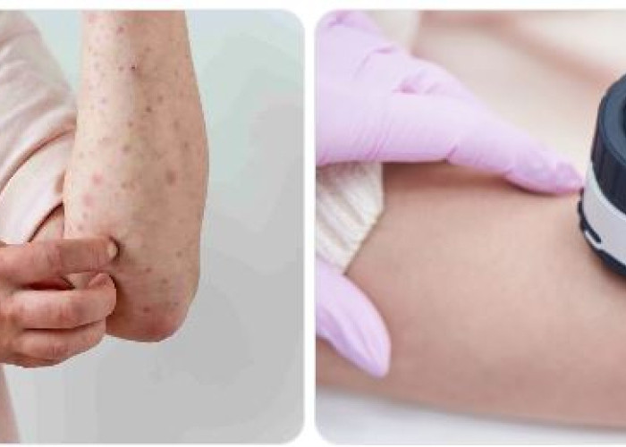 Kanker Kulit: Penyebab, Gejala, dan Pentingnya Deteksi Dini