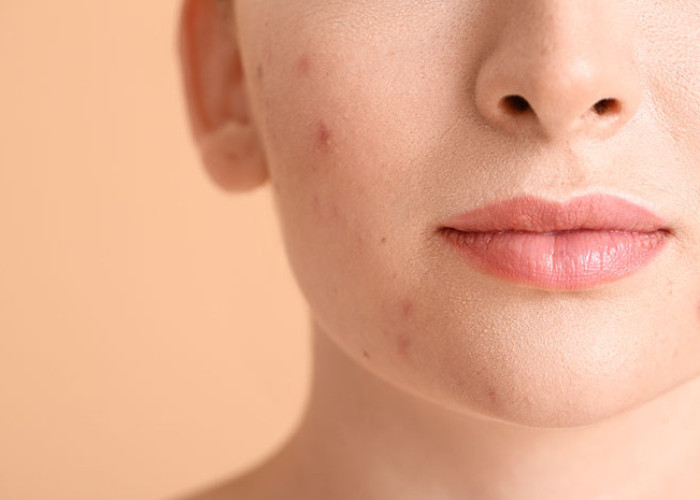 Cara Atasi Kulit Berjerawat dengan Skincare Simple tapi Efektif