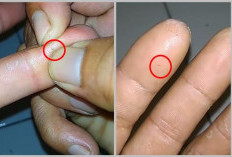 Jangan Panik! Ini Cara Aman Mengeluarkan Duri di Tangan Tanpa Bikin Luka Makin Parah